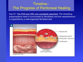 Timeline–  The Progress of Peritoneal Healing Day 91-  The PDS and ORC are completely absorbed . The remaining polypropylene mesh is surrounded by fibroblasts and the neoperitoneum  is supported by a well-organized fibroblast bed. 