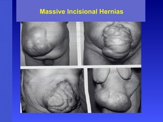 Massive Incisional Hernias 