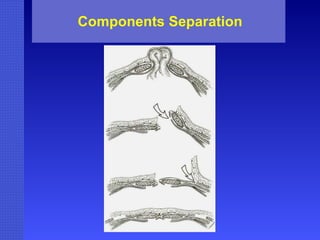 Components Separation 