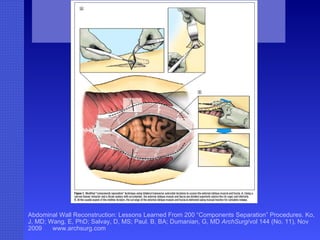 Abdominal Wall Reconstruction: Lessons Learned From 200 “Components Separation” Procedures. Ko, J, MD; Wang, E, PhD; Salvay, D, MS; Paul. B, BA; Dumanian, G, MD  ArchSurg /vol 144 (No. 11), Nov 2009  www.archsurg.com Figure 1. Modified “components separation” technique using bilateral transverse subcostal incisions to access the external oblique muscle and fascia . A, Using a narrow Deaver retractor and a Bovie cautery with and extender, the external oblique muscle and fascia are divided superiorly (above the rib cage) and inferiorly. B, At the caudal aspect of the midline incision, the cut edge of the external oblique muscle and fascia is delivered using manual traction for complete release. 