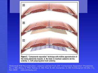 Abdominal Wall Reconstruction: Lessons Learned From 200 “Components Separation” Procedures. Ko, J, MD; Wang, E, PhD; Salvay, D, MS; Paul. B, BA; Dumanian, G, MD ArchSurg/vol 144 (No. 11), Nov 2009  www.archsurg.com Figure 2 “Components separation” technique with midline approximation of the rectus abdominus muscles. A, No mesh. B, Acellular cadaveric dermis underlay. C, Soft polypropylene mesh underlay.  