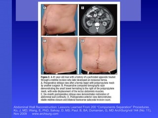 Abdominal Wall Reconstruction: Lessons Learned From 200 “Components Separation” Procedures. Ko, J, MD; Wang, E, PhD; Salvay, D, MS; Paul. B, BA; Dumanian, G, MD ArchSurg/vol 144 (No. 11), Nov 2009  www.archsurg.com Figure 3 A 41-year old man with a history of a perforated appendix treated through a midline incision who later developed an incisional hernia. A, Preoperative oblique view after a hernia repair with polypropylene mesh by another surgeon. B, Preoperative computed tomography scan demonstrating the small bowel herniating to the right of the polypropylene mesh, with wide displacement of the rectus abdominus muscles. C, Six-month postoperative oblique view demonstrates restoration of abdominal wall continuity. D, Postoperative anterior view demonstates stable midline closure and bilateral transverse subcostal incision scars.  