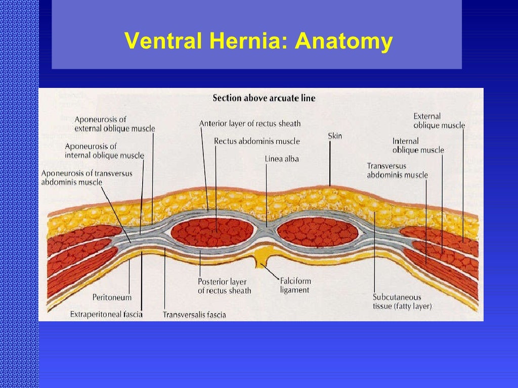 Ventral Hernia Challenges and Choices