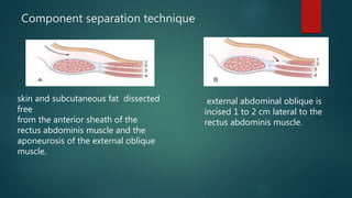 Component separation technique
skin and subcutaneous fat dissected
free
from the anterior sheath of the
rectus abdominis muscle and the
aponeurosis of the external oblique
muscle.
external abdominal oblique is
incised 1 to 2 cm lateral to the
rectus abdominis muscle.
 