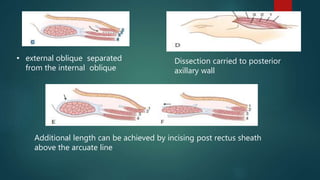 • external oblique separated
from the internal oblique
Dissection carried to posterior
axillary wall
Additional length can be achieved by incising post rectus sheath
above the arcuate line
 