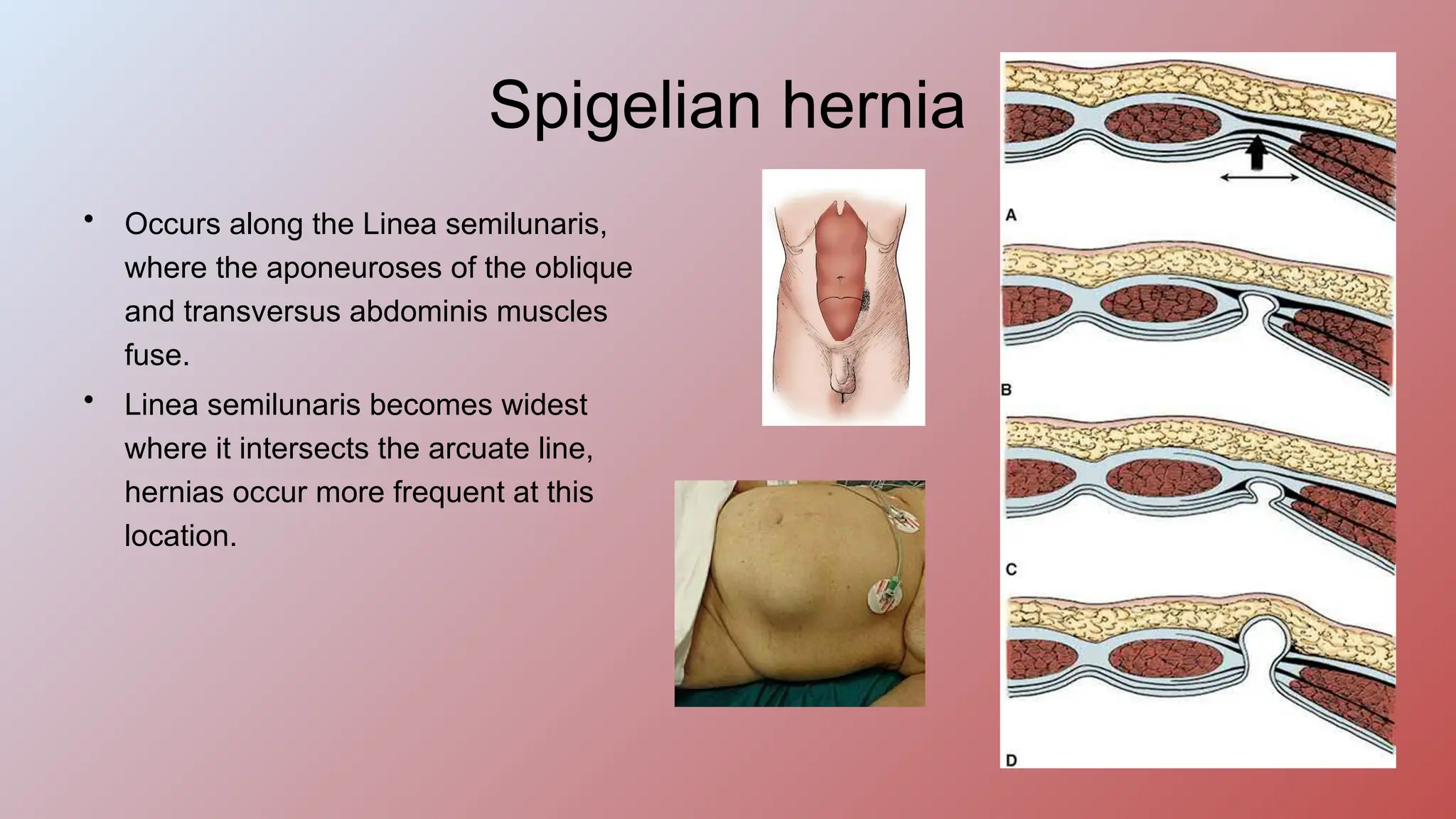Ventral Hernia Repair DEPARTMENT OF GENERAL SURGERY PPTX ventral-hernia-repair-department-of-general-surgery-pptx
