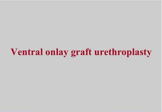 Ventral oral mucosal onlay graft urethroplasty