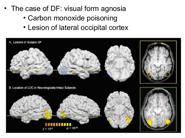 ventral stream visual form agnosia