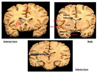 CC
CN
Hippocampus
Anterior horn Body
Inferior horn
 