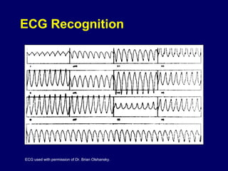 ECG Recognition

ECG used with permission of Dr. Brian Olshansky.

 