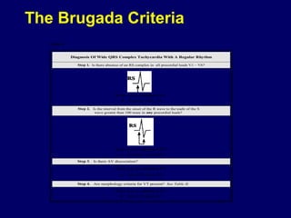 The Brugada Criteria
Table I.

Diagnosis Of Wide QRS Complex Tachycardia With A Regular Rhythm
Step 1. Is there absence of an RS complex in all precordial leads V1 – V6?

If yes, then the rhythm is VT.

•

Sens 0.21 Spec 1.0

Step 2. Is the interval from the onset of the R wave to the nadir of the S
wave greater than 100 msec in any precordial leads?

If yes, then the rhythm is VT.
•

Sens 0.66 Spec 0.98

Step 3. Is there AV dissociation?
If yes, then the rhythm is VT.

•

Sens 0.82 Spec 0.98

Step 4. Are morphology criteria for VT present? See Table II.
If yes, then the rhythm is VT.

•

Sens 0.99 Spec 0.97

 