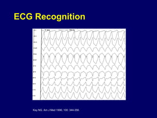 ECG Recognition

Kay NG. Am J Med 1996; 100: 344-356.

 