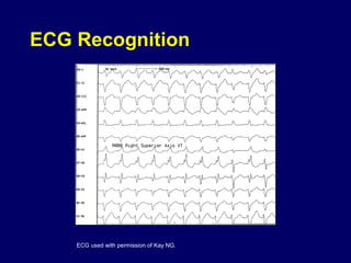 ECG Recognition

ECG used with permission of Kay NG.

 