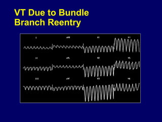 VT Due to Bundle
Branch Reentry

 