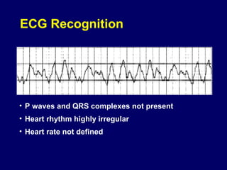 ECG Recognition

• P waves and QRS complexes not present
• Heart rhythm highly irregular
• Heart rate not defined

 