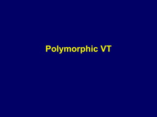 Polymorphic VT

 