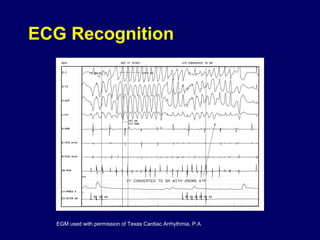 ECG Recognition

EGM used with permission of Texas Cardiac Arrhythmia, P.A.

 
