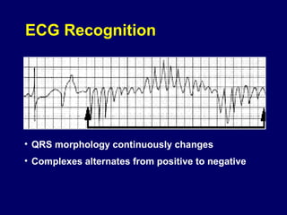 ECG Recognition

• QRS morphology continuously changes
• Complexes alternates from positive to negative

 