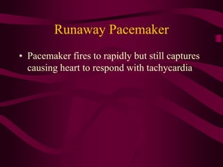 Runawau Pacemaker Ventricular and paced arrhythmias | PPTX