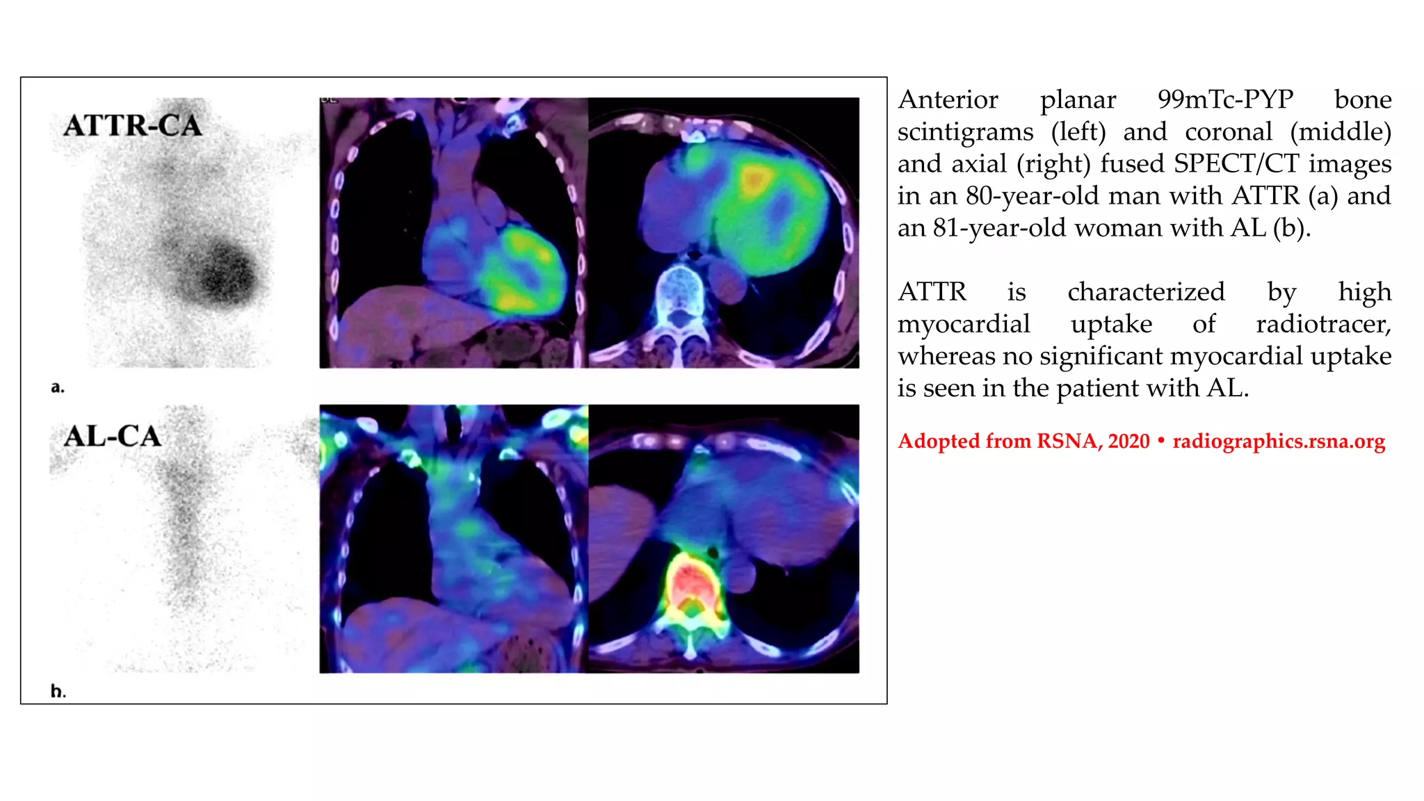 Ventricular Arrhythmias in Cardiac Amyloidosis.pdf | Heart and ...