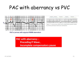 #VENTRICULAR ARRHYTHMIAS NEW.pptx