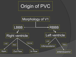 Ventricular arrythmia | PPTX