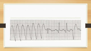 Ventricular Rhy Ventricular arrythmia | PPTX