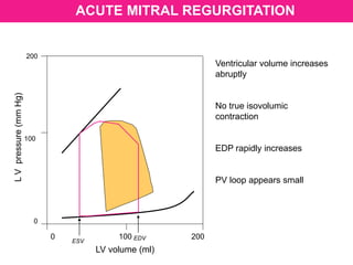 LV volume (ml)
LVpressure(mmHg)
200
100
0
0 100 200
ESV
EDV
ACUTE MITRAL REGURGITATION
Ventricular volume increases
abruptly
No true isovolumic
contraction
EDP rapidly increases
PV loop appears small
 
