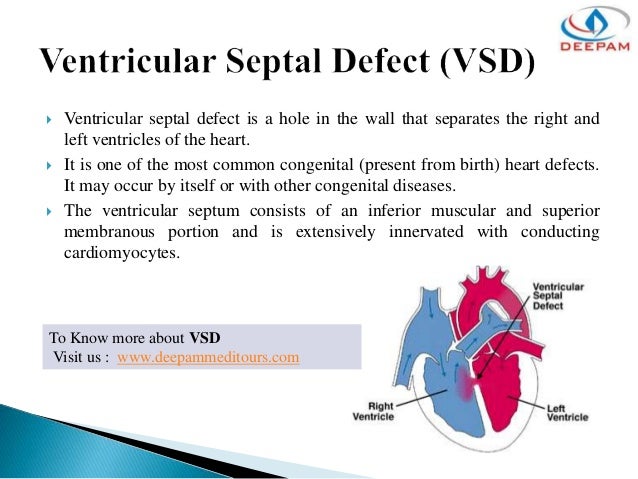 ventricular septal defect diagnosis and treatment 20102015 ventricular septal defect is a common developmental problem where there is a hole in the wall that separates the right and left ventricles of the heart. ventricular septal defect diagnosis and treatment 20102015 ventricular septal defect is a common developmental problem where there is a hole in the wall that separates the right and left ventricles of the heart.