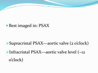 Psax Labels Ventricular septal defect | PPTX