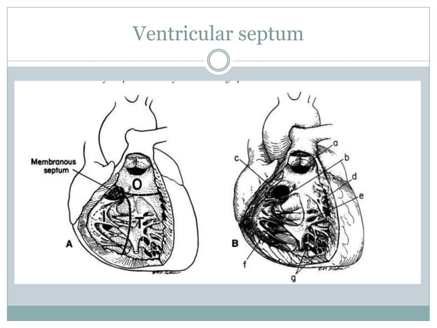 Ventricular septal defects | PPTX