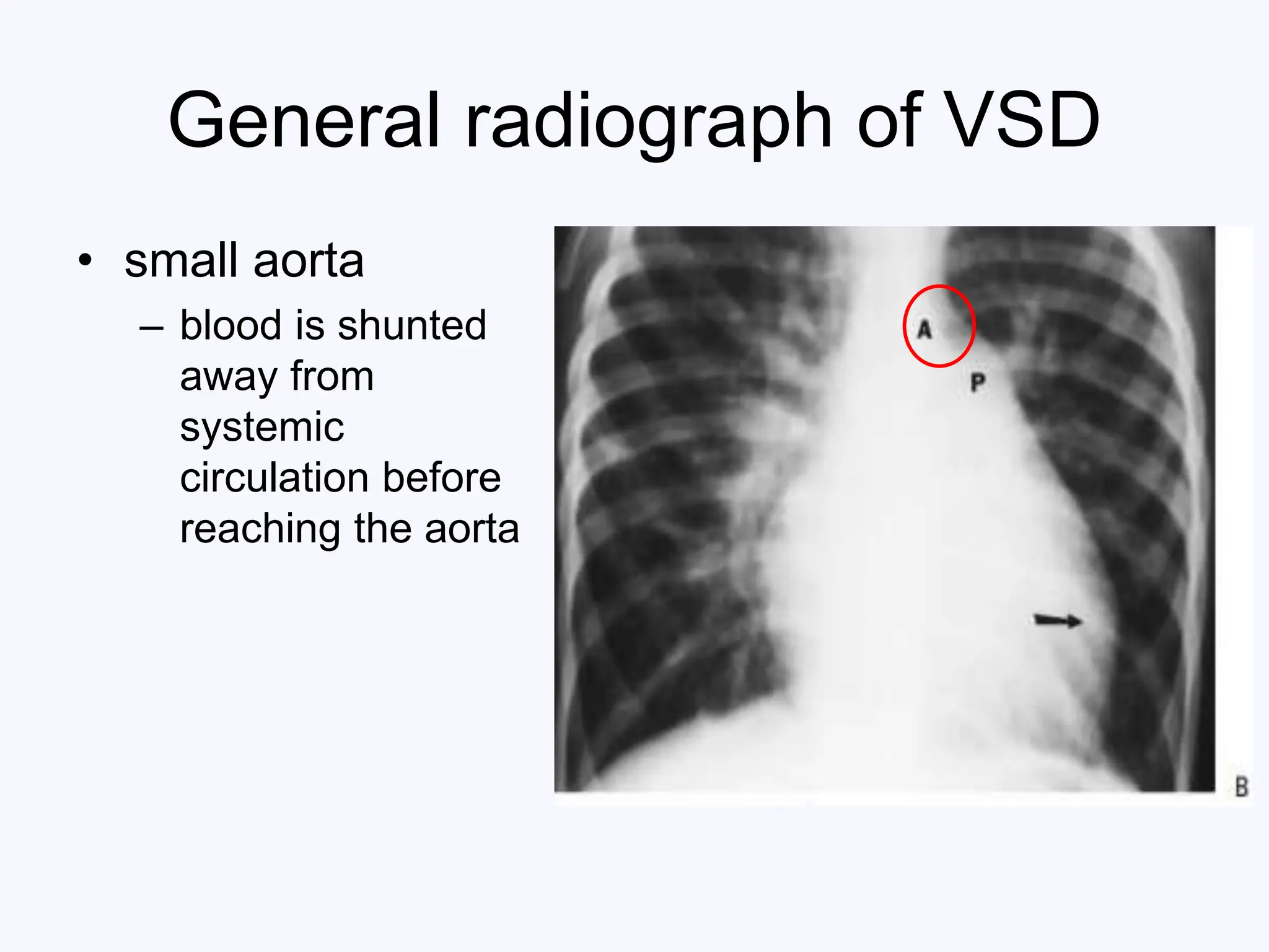 Imaging of Ventricular Septal Defects.ppt