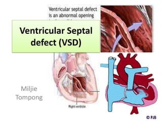 Ventricular Septal
   defect (VSD)



  Miljie
Tompong
 