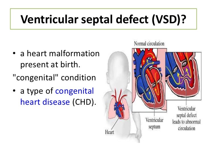 Ventricular septal defect (vsd)