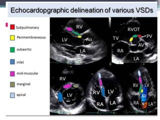 Vsd Incedence Ventricular septal defect (vsd) | PPTX