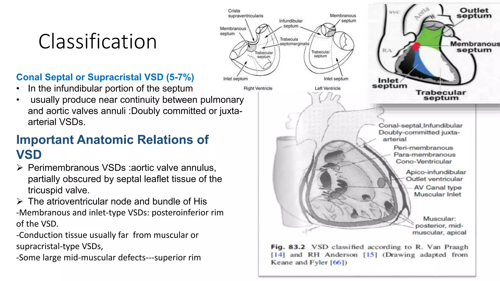 Ventricular septal defect VSD . Firas Aljanadi-Oct 2019 | PPTX | Heart ...