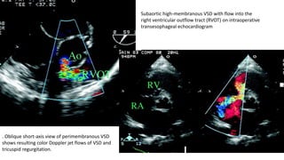 Vsd Color Ventricular septal defect VSD . Firas Aljanadi-Oct 2019 | PPTX