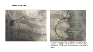 Ventricular septal rupture with cardiogenic shock follows by Inferior ...