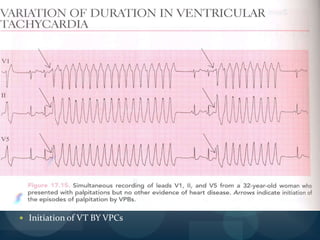 More likely to be VT Brugada signJosephson’s sign