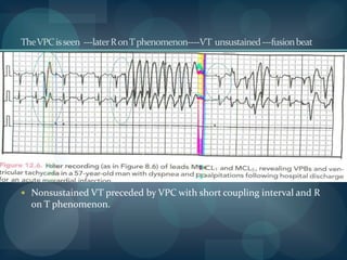 The ladder diagram for ventricular arryhthmias