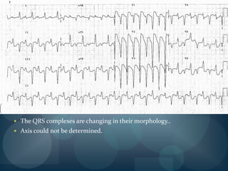 Preceded by long pause and then short cycles..