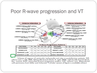 Poor R-wave progression and VT
 