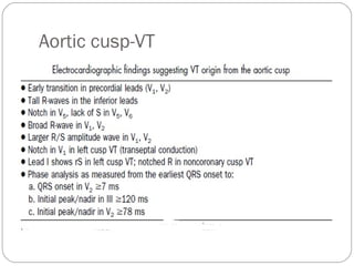 Aortic cusp-VT
 