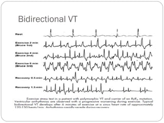Bidirectional VT
 