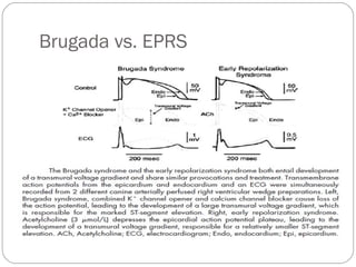 Brugada vs. EPRS
 