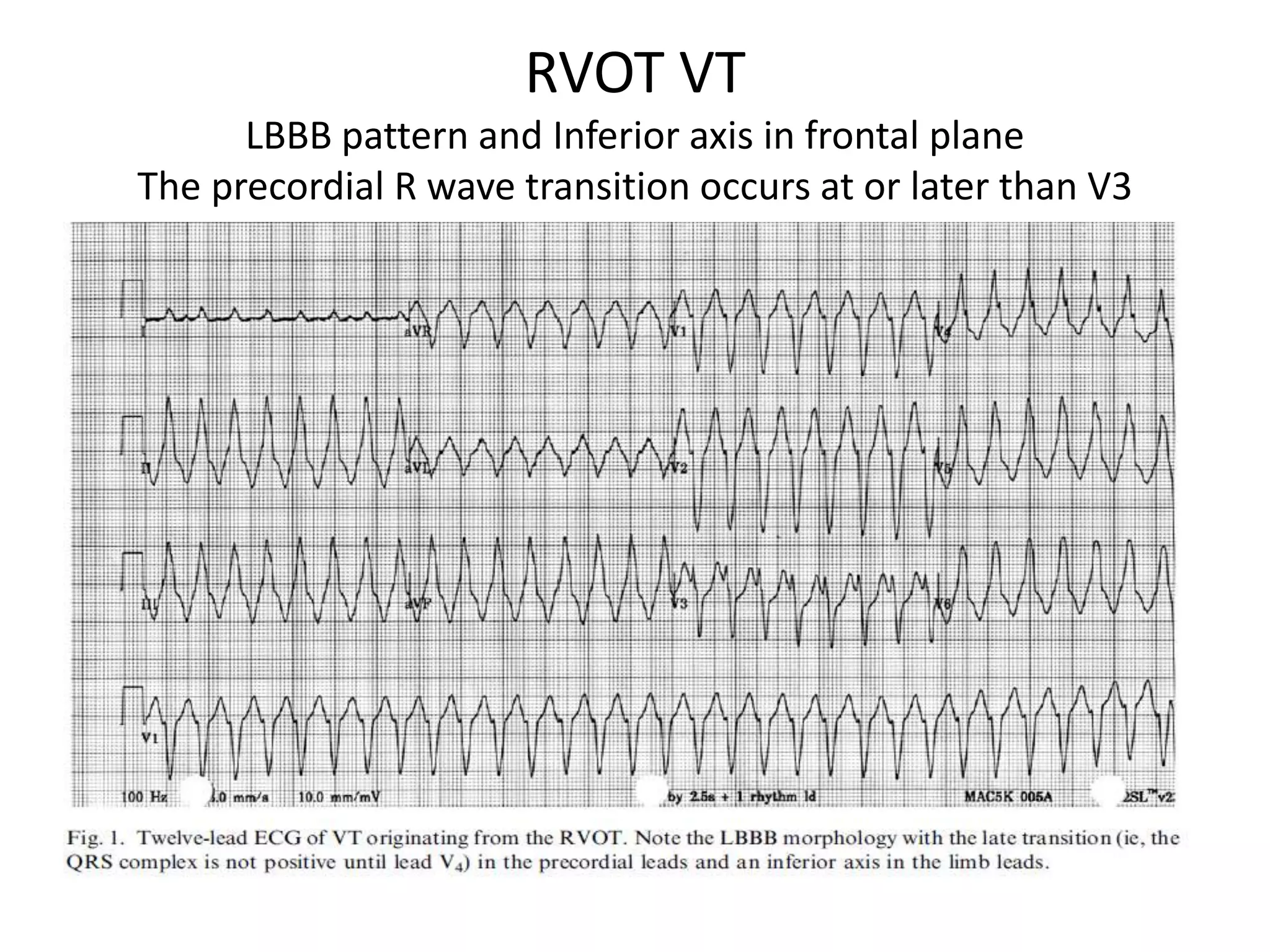 Vt R Wave Ventricular tachycardia | PPTX
