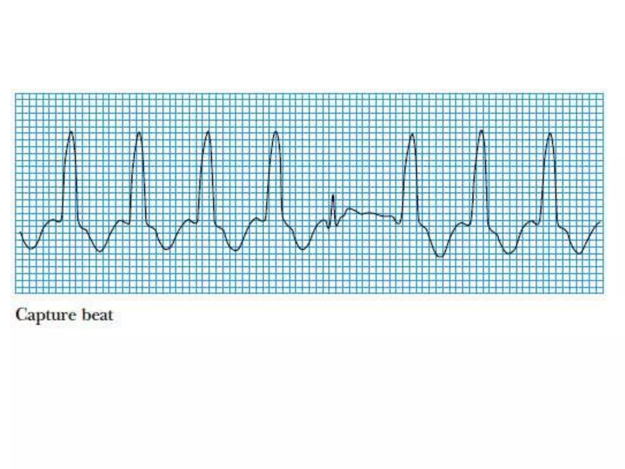 Ventricular tachycardia | PPTX