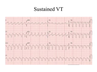 Sustained Vt Algorithm Ventricular tachycardia- ECG based approach | PPTX
