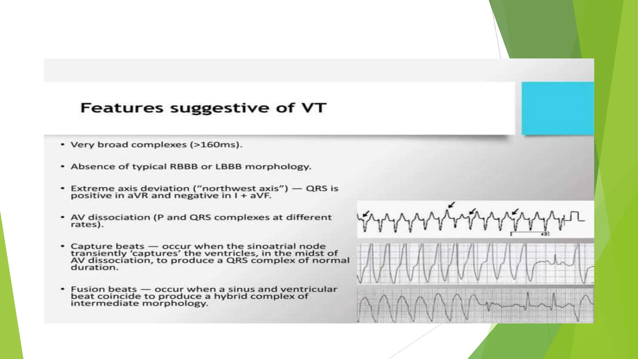 VENTRICULAR TACHYCARDIA..............pptx