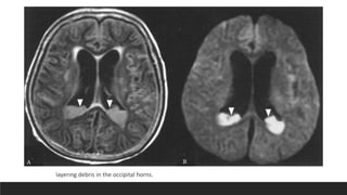 layering debris in the occipital horns.
 
